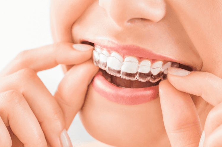 Align Technology's $31.75 Million Settlement Over Antitrust Violations in Dental Aligner Market